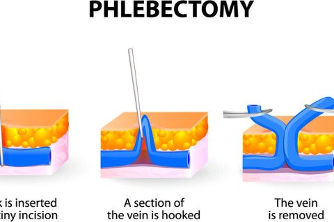 Phelbectomy