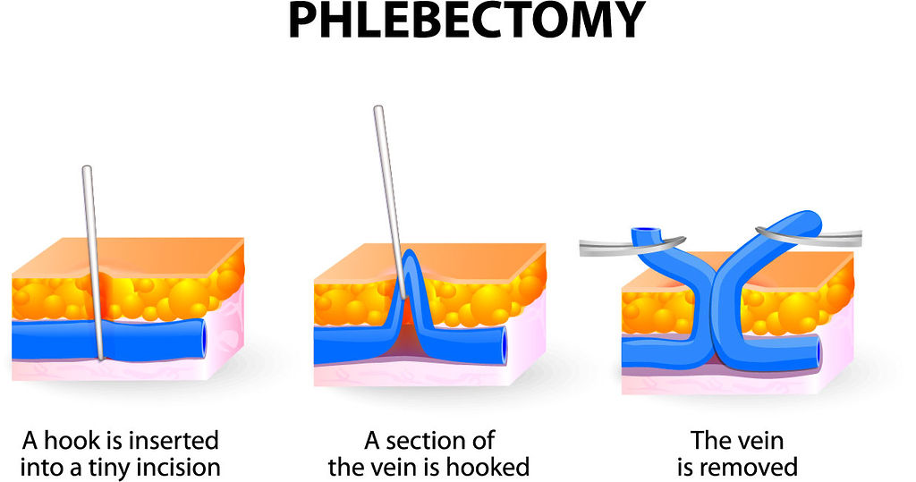 Phelbectomy